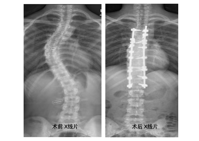 术前、术后x线片